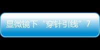 显微镜下“穿针引线”7小时！金湾这家医院成功帮患者保住断肢